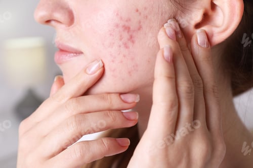 Preview: Woman with acne problem at home, closeup