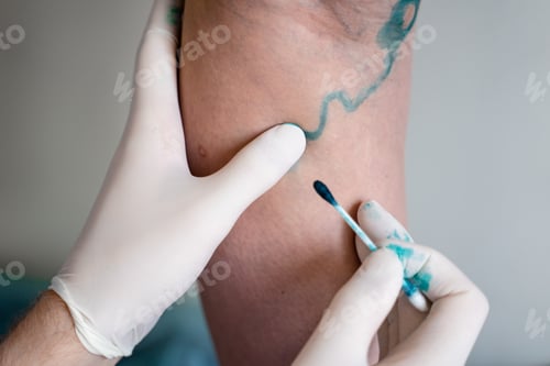 Preview: Treatment of Leg Veins with Cotton Swab