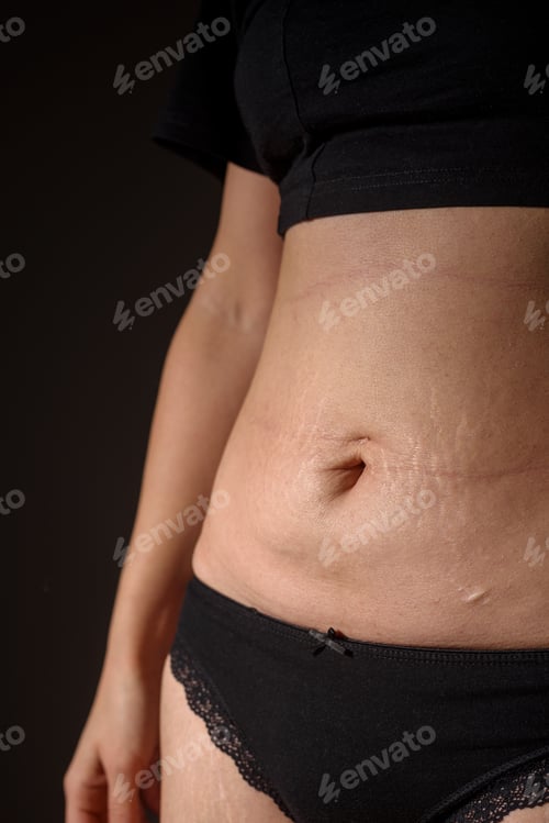 Vista previa: Woman belly with stretch marks and scars