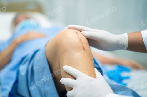 Preview: Asian elderly woman patient show her scars surgical total knee joint replacement
