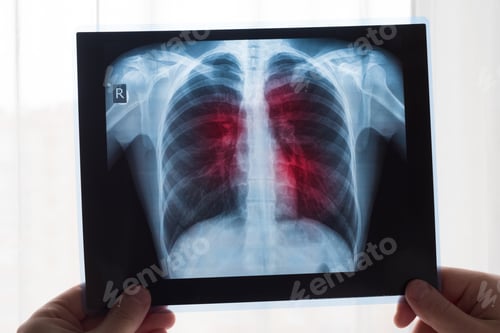 Preview: Lung radiography concept. Radiology doctor examining at chest x ray film of patient Lung Cancer or