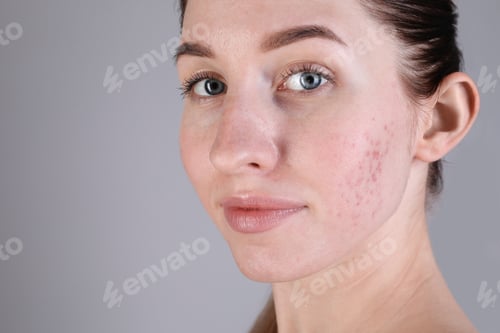 Preview: Young woman with acne problem on light grey background, closeup. Space for text