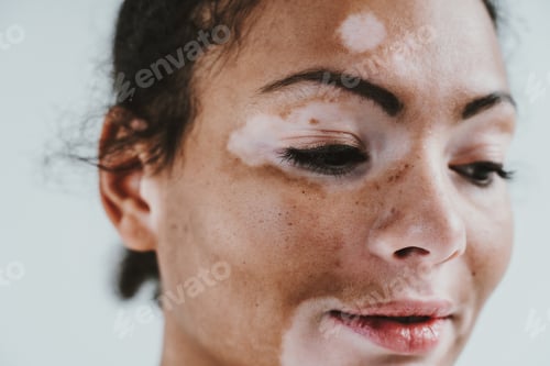 Preview: Beautiful woman with vitiligo skin