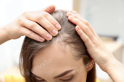 Preview: Young woman with hair loss problem indoors, closeup