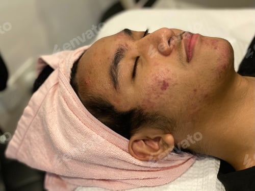 Preview: Acne problems