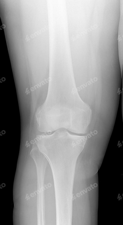 Preview: Vertical shot of a knee and leg x-ray