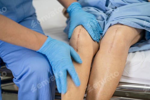 Preview: Asian senior or elderly old lady woman patient show her scars surgical total knee joint replacement