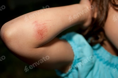 Preview: Young girl with grazed arm