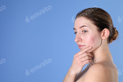 Preview: Young woman with acne problem on blue background. Space for text