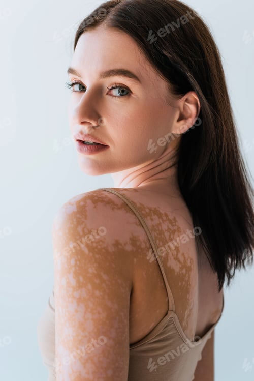 Preview: portrait of brunette young woman with vitiligo looking at camera isolated on grey