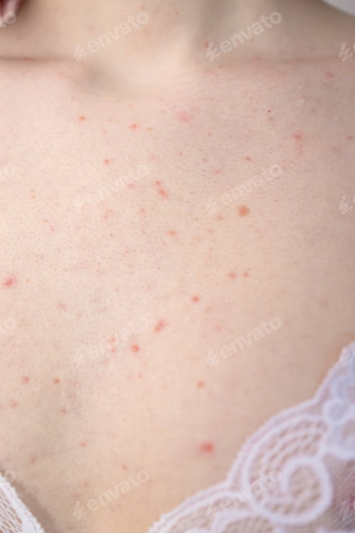 Preview: teenage girl have a lot of red spots on her chest. From acne hormones