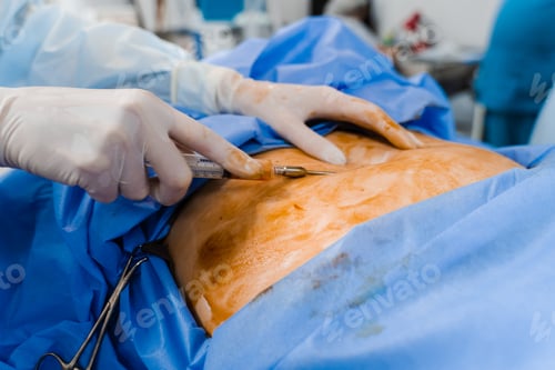 Preview: Liposcution close-up Abdominoplasty Fat removal Body shaping
