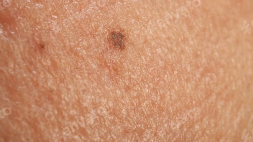 Preview: A close up of human skin with a small dark mole or spot.