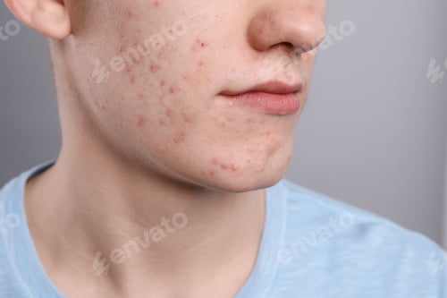 Preview: Young man with acne problem on grey background, closeup