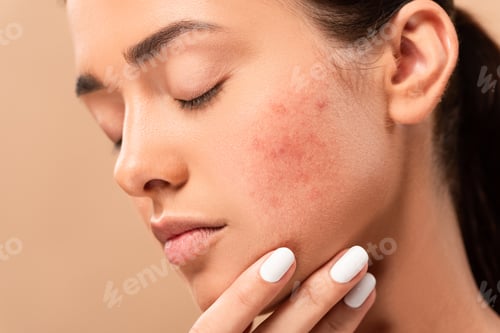 Preview: young woman with closed eyes touching face with acne isolated on beige