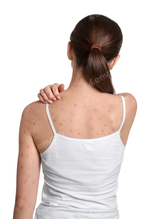 Preview: Woman with rash suffering from monkeypox virus on white background, back view