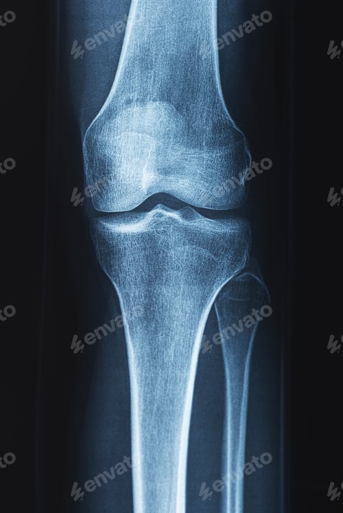 Preview: X-ray of human knee. Problems with bone or joint.