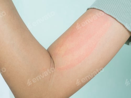 Preview: Hand with Urticaria Allergy Itchy Rash Eczema Itch Woman