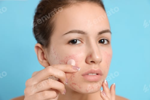 Preview: Teen girl applying acne healing patch on light blue background