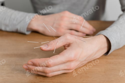 Preview: Man using acupuncture treatment for pain relief
