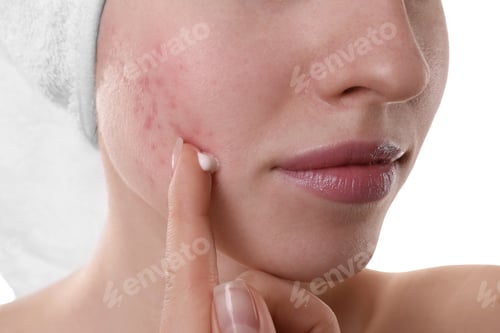 Preview: Young woman with acne problem applying cosmetic product onto her skin on white background, closeup