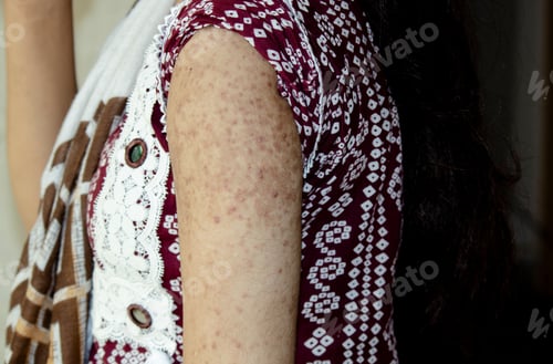 Preview: Closeup of a flaky rash on a shoulder and an arm. The concept of dermatology, fungus allergy