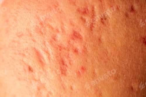 Preview: post-acne, scars and red festering pimples on the face of a young woman.