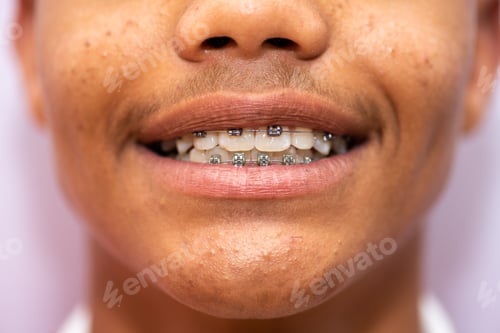 Preview: Close up shot of person with braces in their mouth