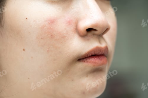 Preview: Asian young with pimple, acne, scar on skin, facial problem.