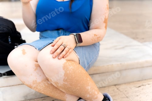 Preview: Woman showing vitiligo skin condition while sitting outdoors