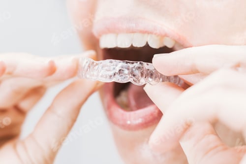Preview: mouth with transparent retainer