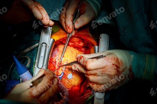 Preview: Heart surgery. Open heart surgery suture greater saphenous vein coronary artery bypass surgery