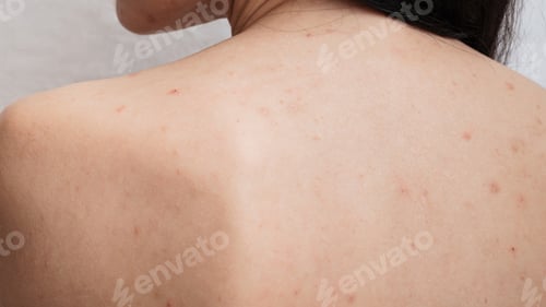 Preview: A close-up of a panoramic shot of a woman's skin prone to acne and other dermatological problems.