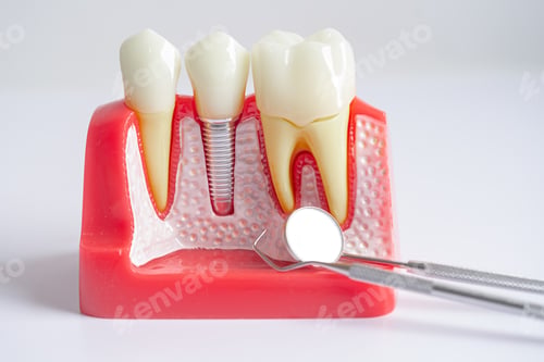 Preview: Dental implant, artificial tooth roots into jaw, root canal of dental treatment, gum disease