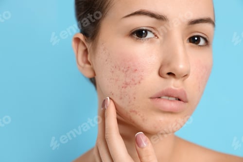 Preview: Teen girl with acne problem on light blue background