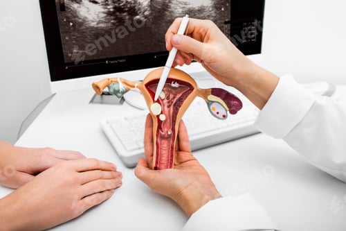 Preview: Close-up anatomical model of the uterus with pathologies. Gynecologist showing the polyps of the