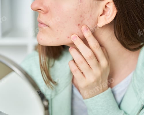 Preview: Young woman with problem skin looking at mirror and sees blackheads on skin