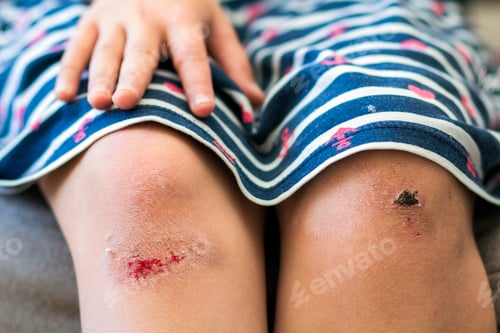 Preview: Close-up of little girl holding her bruised injured damaged knee with her hands