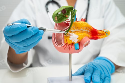 Preview: Pancreatitis, pancreatic cancer, Asian doctor with pancreas, gallbladder