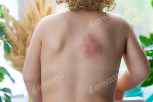 Preview: Mosquito bites on a child back. Selective focus.