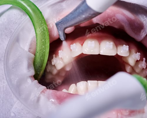 Vista previa: Close-up picture of a woman's mouth during dental procedure of cleaning teeth