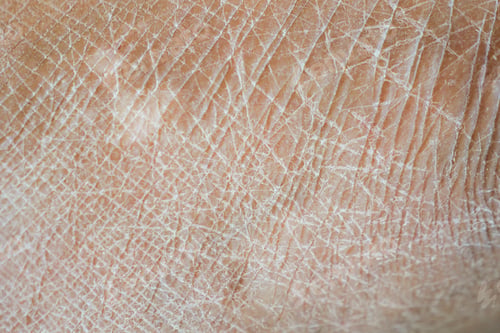 Preview: Closeup view of dry human skin .