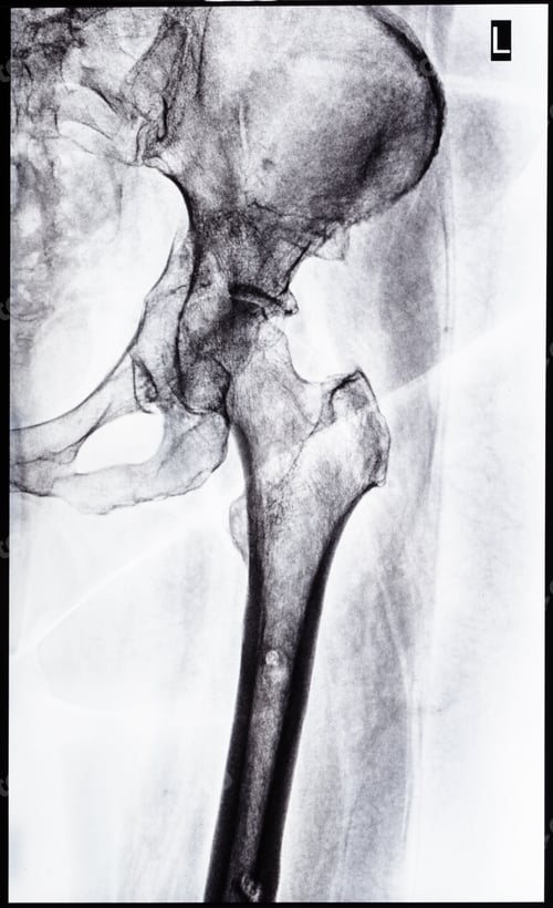 Preview: x-ray of junction of tibia and pelvis after healed
