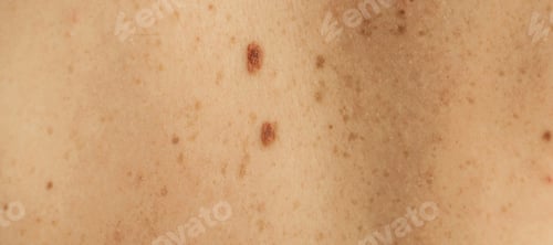 Preview: Skin on a man back with scattered moles