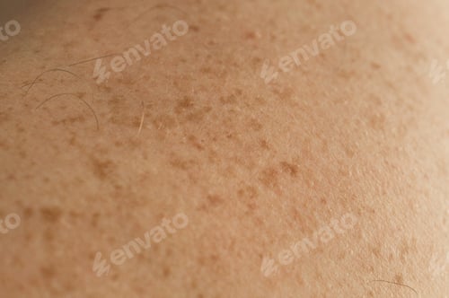Preview: Skin on a man back with scattered moles