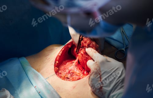 Preview: Doctors performing abdominoplasty or tummy tuck surgery in clinic.
