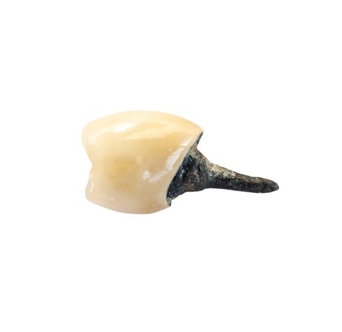 Preview: used dental implant with ceramic tooth crown