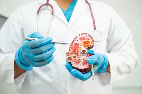 Preview: Kidney disease, Chronic kidney disease ckd, Doctor hold model to study and treat in hospital.
