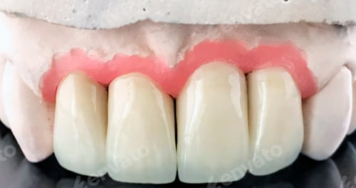 Preview: Ceramic dental bridge on plaster model. Dental prosthesis manufacturing workshop