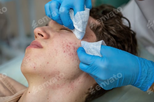 Preview: Treatment of acne in adolescents. Facial peeling to fight acne on the face